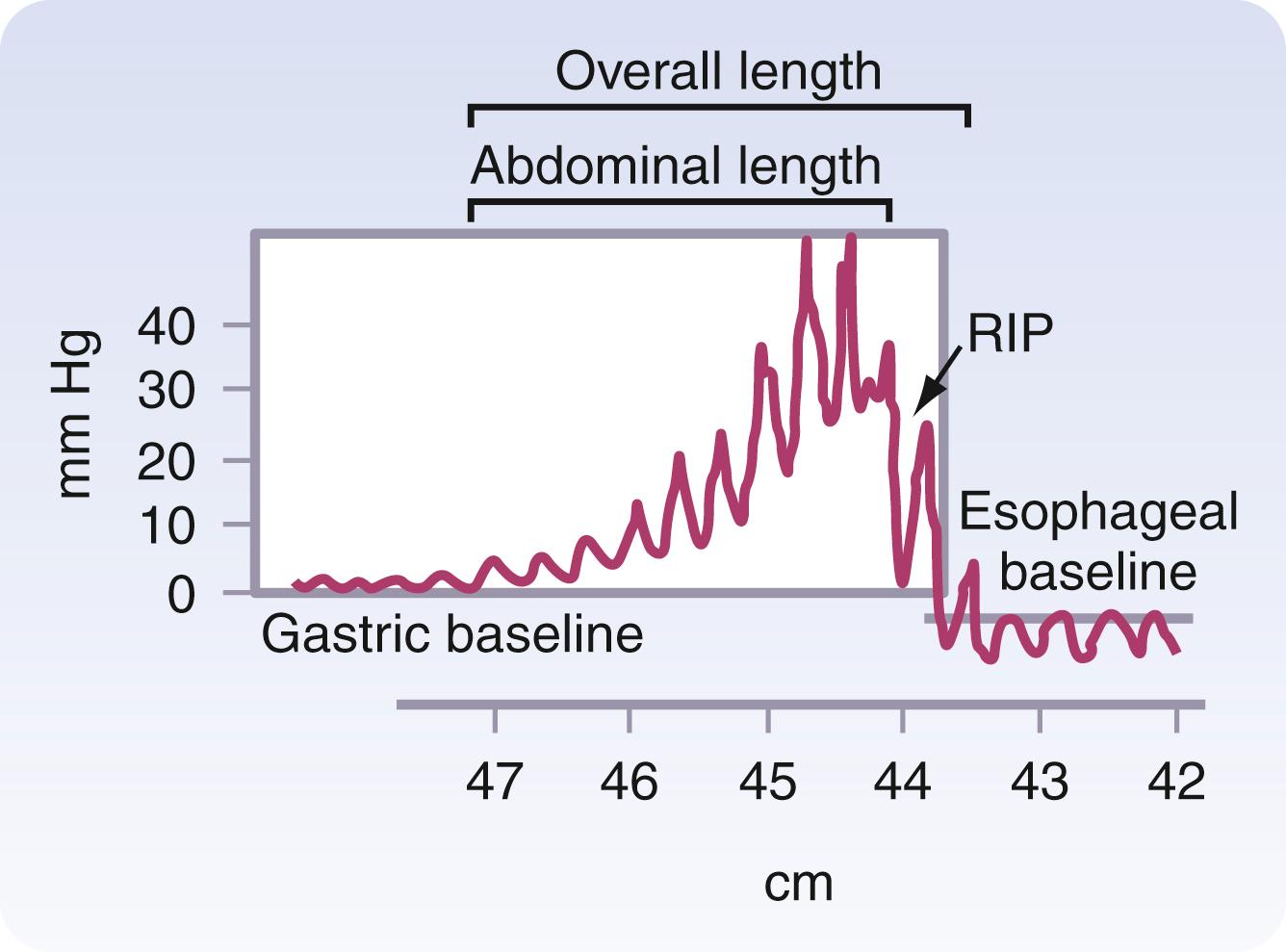 Fig. 42.15, Normal lower esophageal sphincter. (From Bremner CG, DeMeester TR, Bremner RM, et al. Esophageal motility testing made easy . St Louis: Quality Medical Publishing; 2001:15.) RIP , Respiratory inversion point.