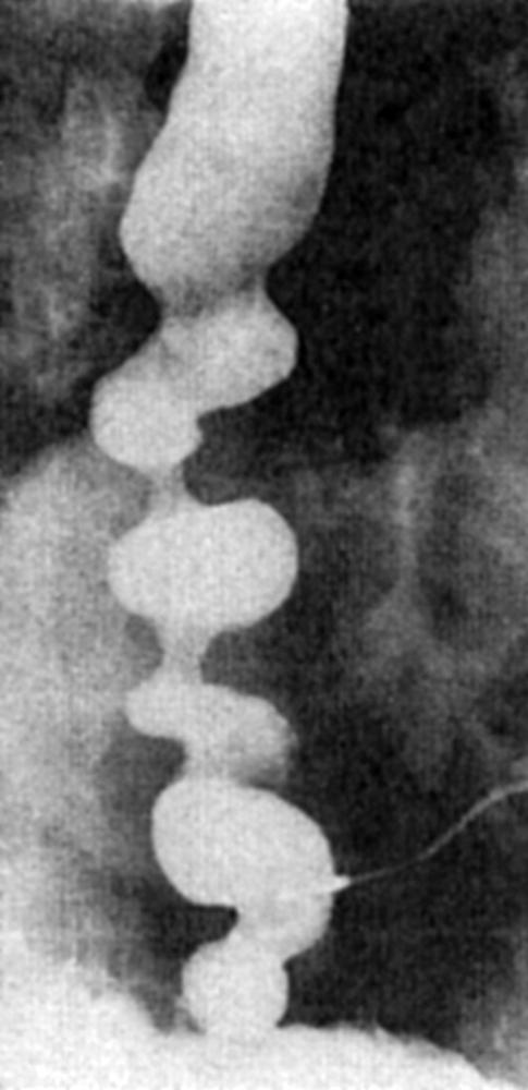 Fig. 42.17, Barium esophagram of diffuse esophageal spasm.