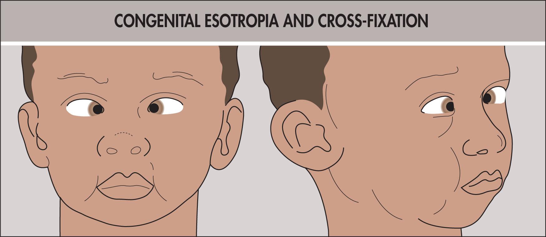 Fig. 11.6.2, Congenital Esotropia and Cross-Fixation.