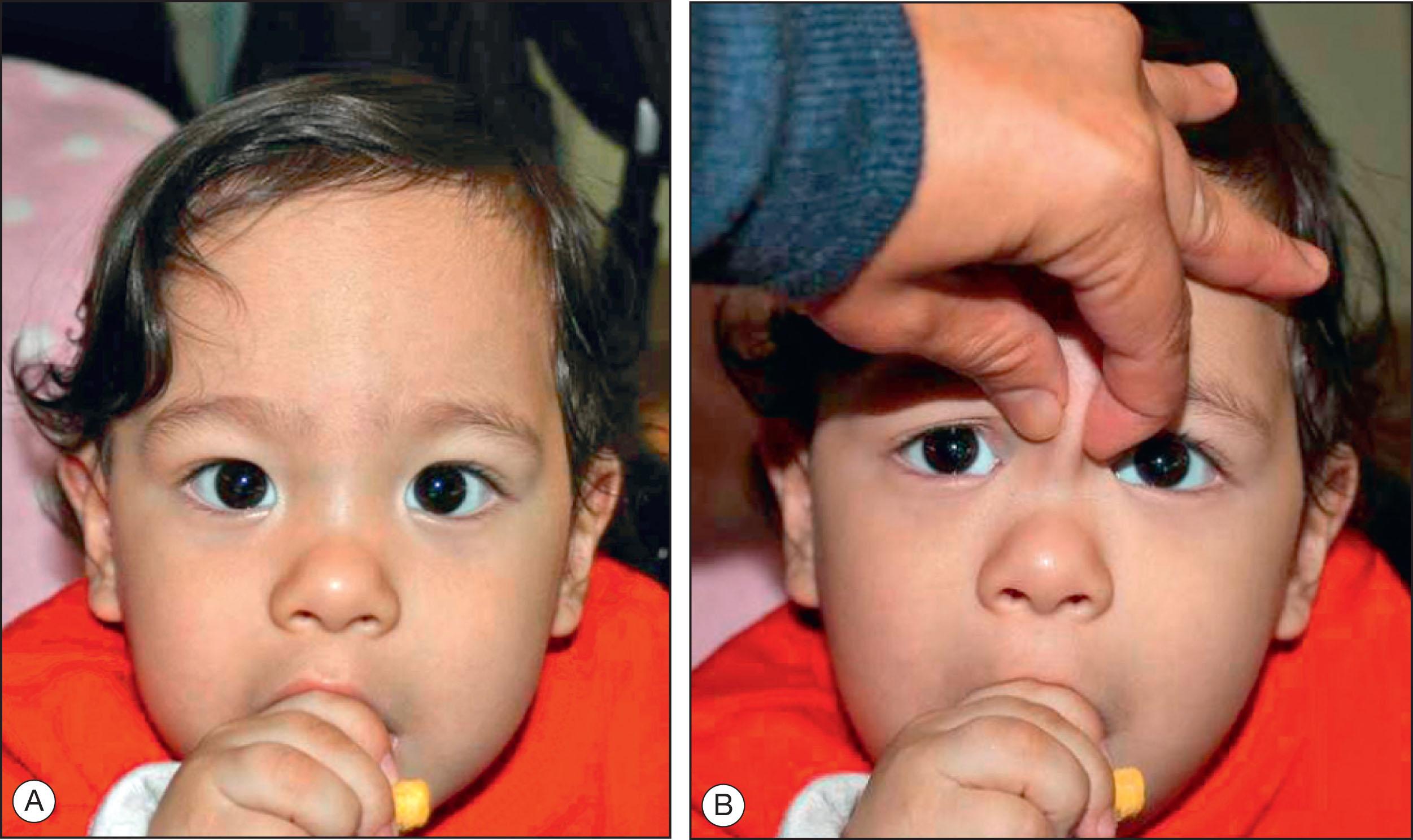 Fig. 11.6.5, Pseudoesotropia.