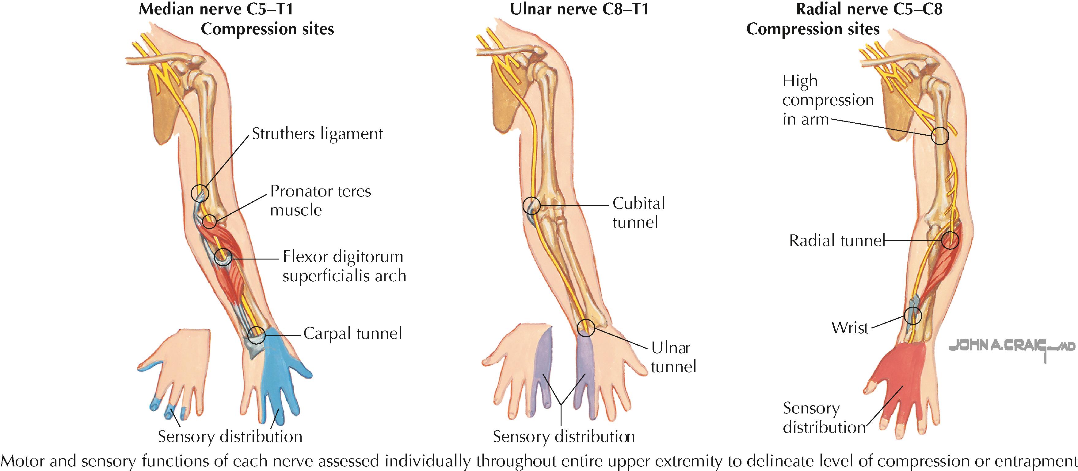 Figure 102.1, Common sites of upper extremity nerve entrapment.