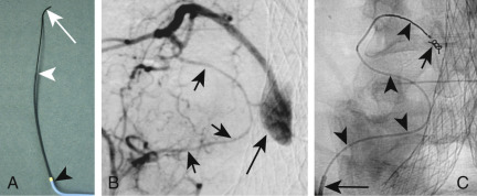 Fig. 13.1, (A) Microcatheters will negotiate the most tortuous vessels; 4Fr guide-catheter (black arrowhead), microcatheter (white arrowhead) and wire (white arrow). (B) Tiny iliolumbar collaterals (short black arrows) causing type II endoleak (long black arrow) following endovascular aortic aneurysm repair. (C) Microcatheters will negotiate the most tortuous vessels. Microcatheter (arrowheads) delivering embolization coils (short black arrow) into the lumbar artery. 4Fr guide-catheter in the iliolumbar branch of the internal iliac artery (long black arrow).