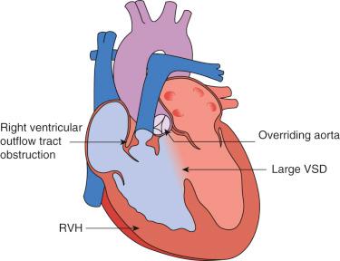 FIGURE 16.1, The anatomic features of tetralogy of Fallot are depicted, consisting of right ventricular outflow tract obstruction (may occur at any or a combination of valvar, subvalvar, and supravalvar levels), a large ventricular septal defect ( VSD ), aortic override, and right ventricular hypertrophy ( RVH ). The purple color in the aorta represents arterial desaturation from intracardiac right to left shunting. Note the infundibular narrowing and the hypoplastic pulmonary arteries.