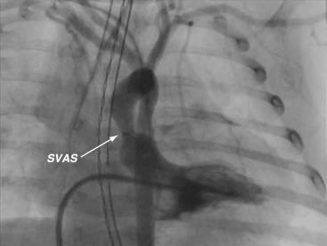 FIGURE 16.12, The angiogram displays the classic angiographic appearance of supravalvar aortic stenosis ( SVAS, arrow ) in a child with Williams syndrome.