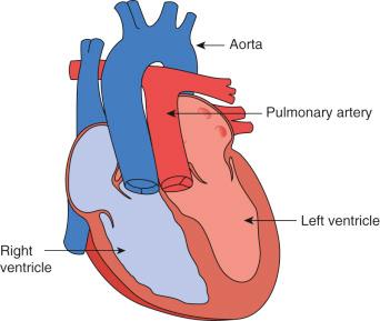 FIGURE 16.2, Diagrammatic representation of d -transposition of the great arteries displaying the discordant ventriculoarterial connections. In this lesion the right ventricle ejects blood into the aorta and the left ventricle ejects blood into the pulmonary artery. Intercirculatory mixing is essential for survival in this anomaly.