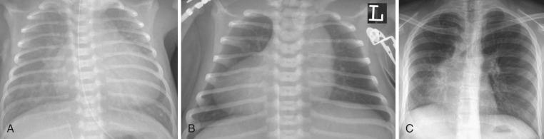 FIGURE 16.3, Chest radiographs demonstrate various cardiac positions within the thorax. A, Levocardia (left-sided position). B, Dextrocardia (right-sided position). C, Mesocardia (centrally located cardiac mass).