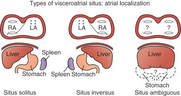 FIGURE 16.4, Three types of visceroatrial situs are shown. Situs solitus indicates a normal arrangement of the viscera and atria, with the right atrium ( RA ) on the right side and the left atrium ( LA ) on the left side. The stomach and spleen are on the left, and the liver is on the right. Situs inversus indicates inverted arrangement of viscera and atria, with the RA on the left side and the LA on the right side, as in a mirror image of situs solitus. In visceral situs inversus, the stomach and spleen are on the right, and the liver is on the left. Situs ambiguous denotes that the visceroatrial situs is anatomically uncertain or indeterminate because the anatomic findings are ambiguous.