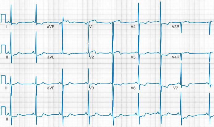 FIGURE 16.5, The electrocardiogram from an adolescent with hypertrophic cardiomyopathy demonstrates left ventricular hypertrophy (i.e., deep S wave in V 1 and tall R waves over the left precordial leads). The ST-segment depression and T-wave inversion over the left precordial leads are related to repolarization changes associated with left ventricular hypertrophy, also known as a strain pattern . Reciprocal ST-segment elevation can be seen over the right precordial leads. This recording is consistent with sinus bradycardia (heart rate average of 50 beats/minute).