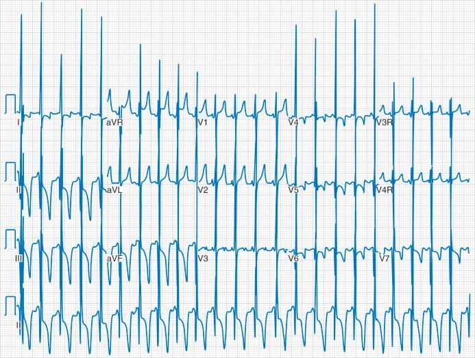 FIGURE 16.6, Pompe disease is an inherited disorder characterized by the accumulation of glycogen in cells. The electrocardiographic tracing for an infant with this glycogen storage disease and a severe form of hypertrophic cardiomyopathy displays dramatic right and left ventricular voltages, in addition to ST-segment and T-wave abnormalities. The recording is displayed at full standard (10 mm/mV), meaning that the electrocardiogram was not reduced in size to fit on the paper.