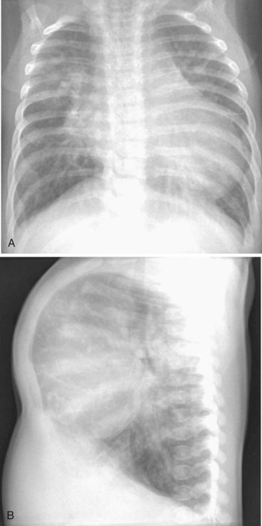 FIGURE 16.7, Chest radiographs of a young child with dilated cardiomyopathy in the posteroanterior (A) and lateral (B) projections demonstrate moderate to severe cardiomegaly and pulmonary vascular congestion.