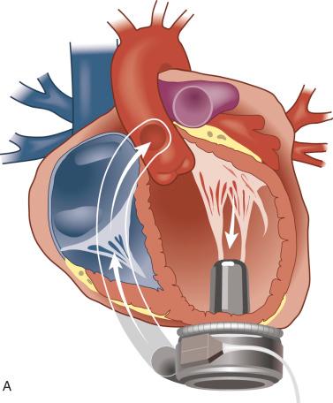 FIGURE 16.8, Mechanical circulatory support may be required in children with dilated cardiomyopathy (DCM) and severe cardiac dysfunction. A, HeartWare ventricular assist system (HeartWare LVAD, Framingham, MA). This miniaturized implantable device consists of a small continuous-flow pump with integrated inlet cannula placed in the left ventricle, an outflow graft placed in the aorta (not radiopaque), and a driveline that connects to an external controller with a power source. B, Chest radiograph of a child with end-stage DCM after placement of HeartWare ventricular assist device for circulatory support as a bridge to cardiac transplantation.