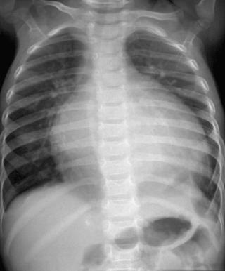 FIGURE 16.9, The chest radiograph of a child with acute myocarditis shows severe cardiomegaly and mildly increased pulmonary vascularity.