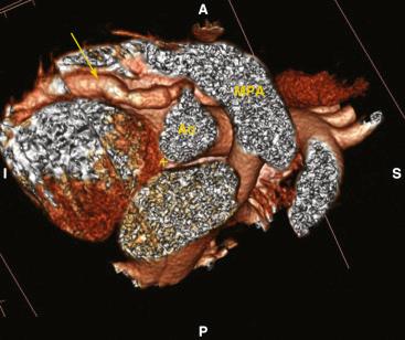 FIGURE 16.10, Magnetic resonance reconstruction at the level of the great vessels in a child with Kawasaki disease demonstrates a large, fusiform coronary artery aneurysm ( arrow ). A , anterior; Ao , aorta; I , inferior; MPA , main pulmonary artery; P , posterior; S , septal.