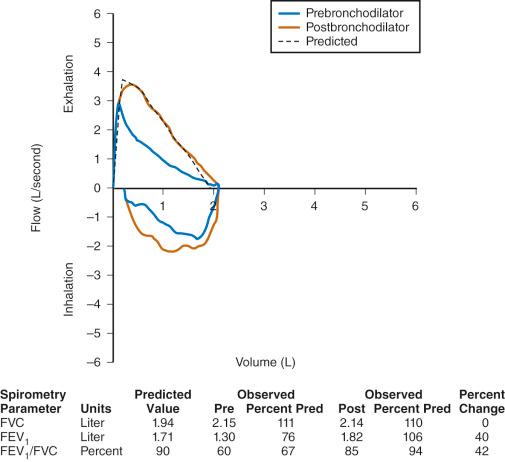 FIGURE 13.3, This flow–volume curve demonstrates a reversible obstructive defect. The forced expiratory volume in 1 second (FEV 1 ) as a percentage of forced vital capacity (FVC), or total volume exhaled, is decreased in patients with airway obstruction. The observed curve shape before bronchodilator use (blue curve) is scooped. After administration of a short-acting bronchodilator, the observed curve shape (brown) appears normal, and there is an increase in both FEV 1 /FVC and FEV 1 . This child has asthma and demonstrates a marked (40%) increase in FEV 1 after treatment with a short-acting bronchodilator. Reversible airflow obstruction is one of the hallmarks of asthma. Post, postbronchodilator; Pre, prebronchodilator; Pred, predicted value.