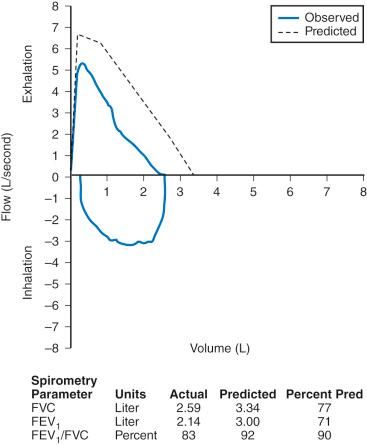 FIGURE 13.4, Flow–volume curve demonstrating a restrictive defect. The flow–volume curves in children with restrictive defects are near-normal in configuration but smaller in all dimensions. The ratio of forced expiratory volume in 1 second (FEV 1 ) to forced vital capacity (FVC) is normal, but both FEV 1 and FVC are reduced. The curve shape appears normal. This child has interstitial lung disease. Pred, predicted value.