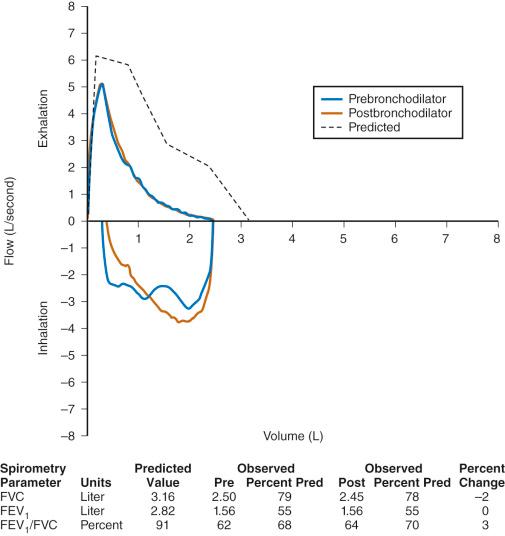 FIGURE 13.5, Pulmonary function test demonstrating a nonreversible obstructive defect. The ratio of forced expiratory volume in 1 second (FEV 1 ) to forced vital capacity (FVC) is decreased, as is the FEV 1 . After administration of a short-acting bronchodilator, there is no significant improvement in the FEV 1 , in contrast to the pattern in Fig. 13.3 . This child has cystic fibrosis with a nonreversible obstructive defect. Post, postbronchodilator; Pre, prebronchodilator; Pred, predicted value.