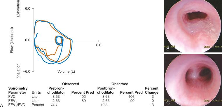 FIGURE 13.7, A, Pulmonary function test from a child with an intrathoracic airway obstruction (vascular ring). The flow–volume curves suggest a fixed expiratory obstruction. The shape of the inspiratory link is normal; the expiratory flow limb is flattened on both the prebronchodilator (brown) and postbronchodilator (blue) flow–volume curves. B, Slit-like tracheal compression before repair. C, Marked improvement in the tracheal lumen after division of the vascular ring. (See E-Fig. 13.1 for a magnetic resonance imaging angiogram of a vascular ring.) FEV 1 , Forced expiratory volume in 1 second; FVC, forced vital capacity; Pred, predicted value.