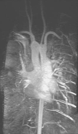 E-FIGURE 13.1, A magnetic resonance angiogram accompanies the flow loop in Fig. 13.7 , demonstrating anomalous aortic anatomy compressing the trachea.