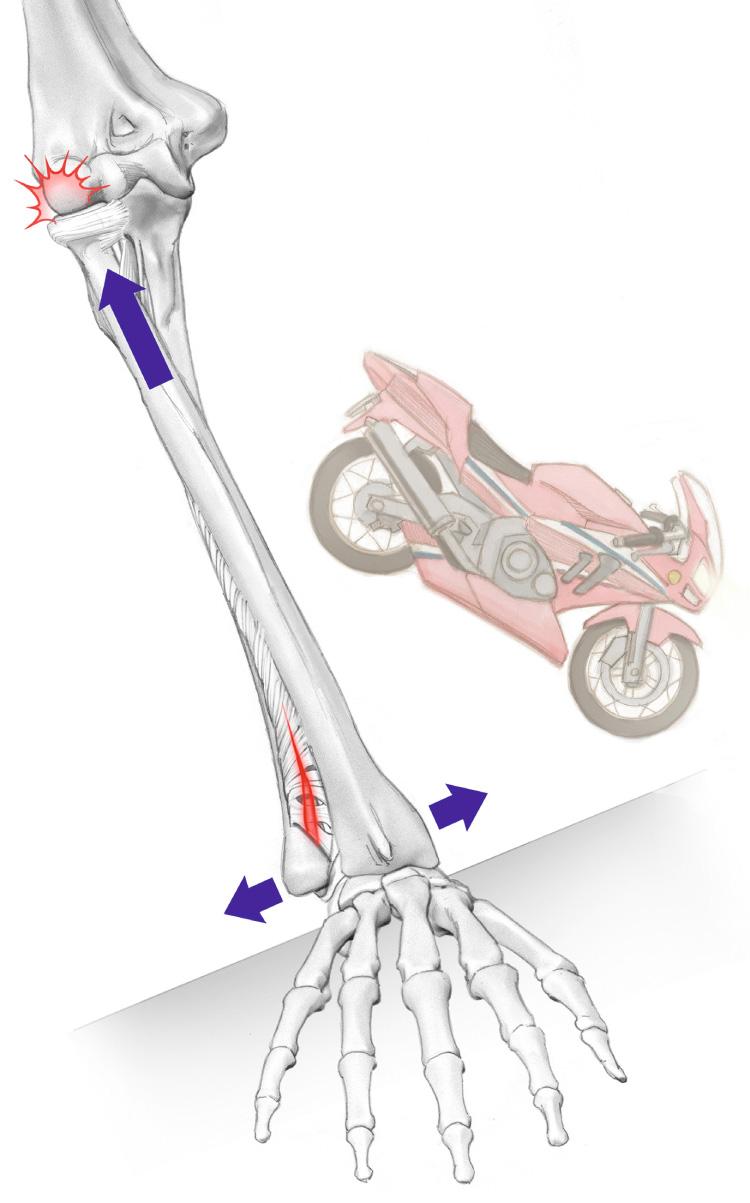 FIG 41.1, Drawing showing a proposed mechanism of axial injury of the forearm leading to Essex-Lopresti type of injury.