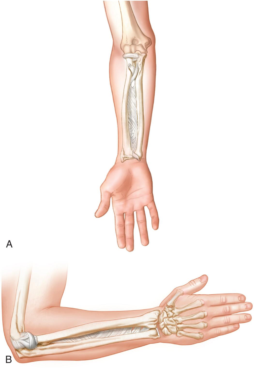 FIG 41.2, Drawing of the forearm showing frontal (A) and lateral (B) anatomic details of the interosseous membrane, and distal and proximal radioulnar joint ligaments.