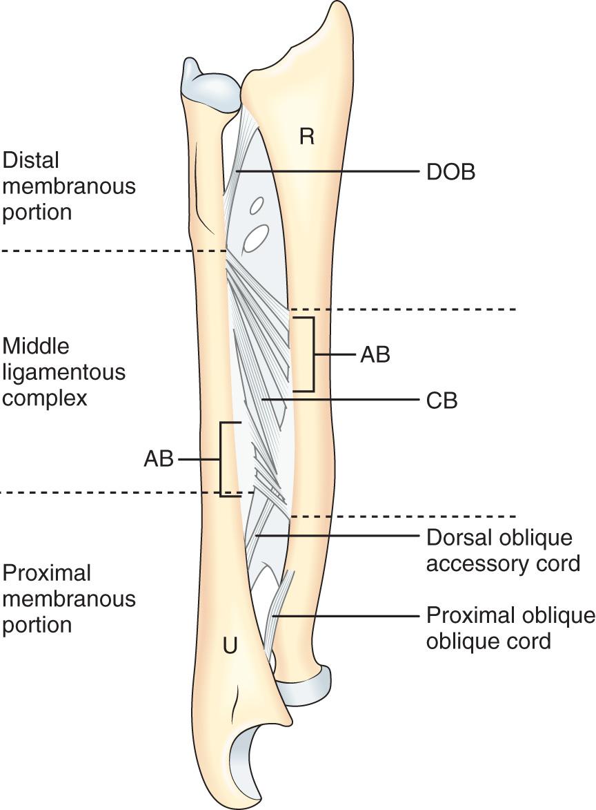 FIG 41.3, Illustration of anatomic composition of the interosseous membrane of the anterior forearm. The three portions include the middle portion with a stout ligamentous complex and the proximal and distal portions, which are membranous and thin. The distal portion containing the distal oblique bundle (DOB), the middle complex containing central (CB) and accessory (AB) bands, and the proximal portion containing the dorsal oblique accessory cord posteriorly on the membrane and the proximal oblique cord anteriorly on the membrane.