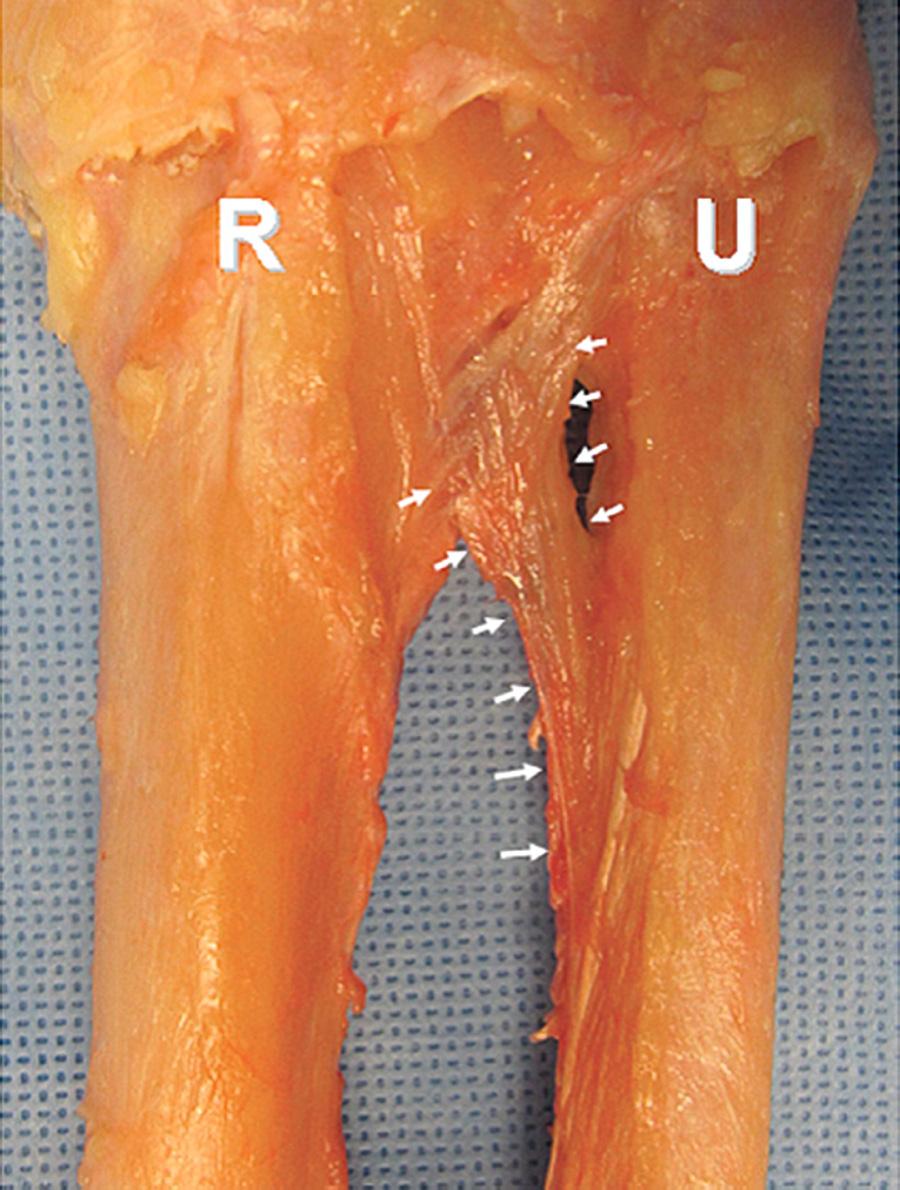 FIG 41.5, Anatomic dissection showing thickened structure of the distal oblique bundle (white arrows) .