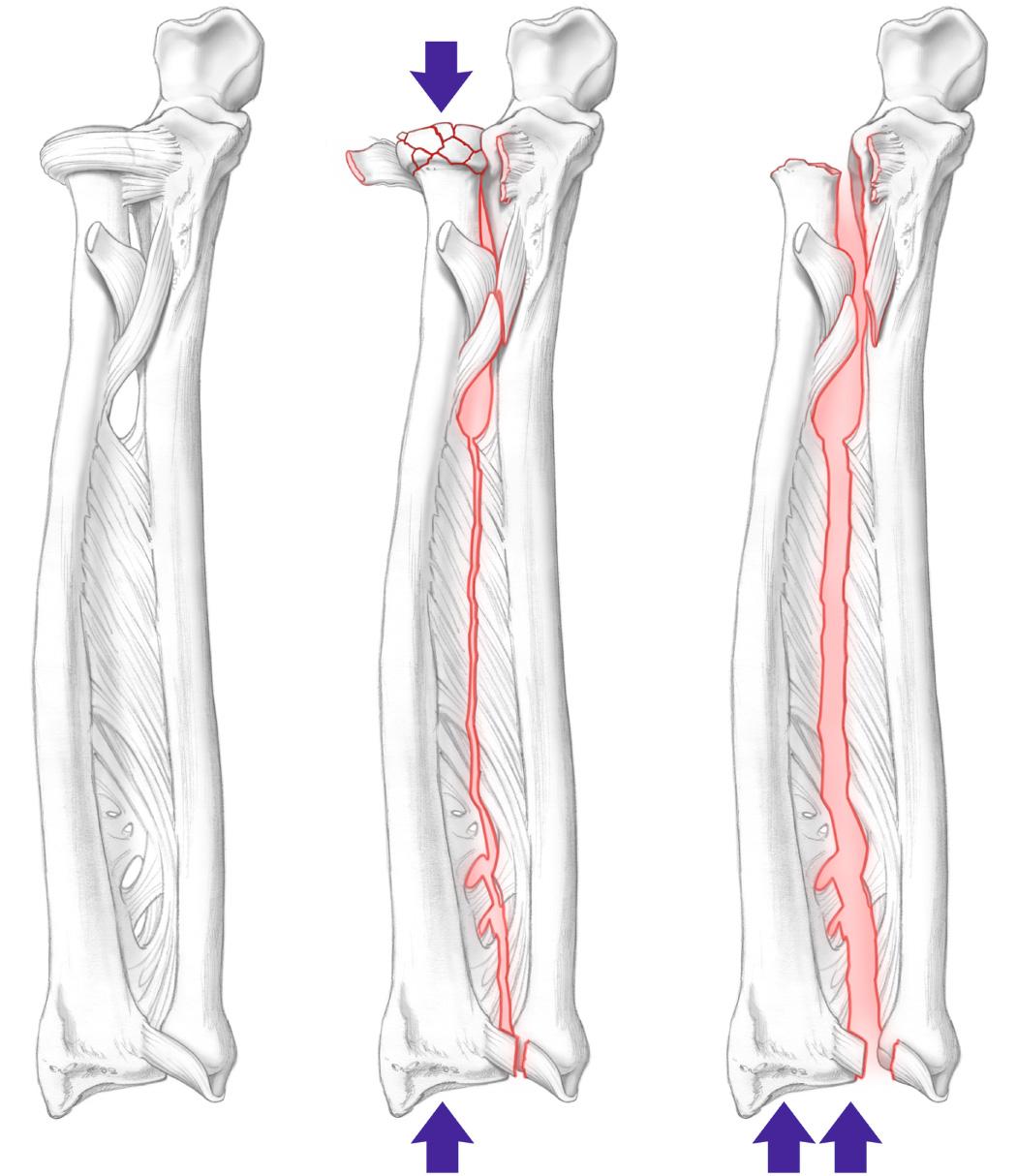 FIG 41.6, Drawing showing how disruption of the anatomy of the forearm leads to Essex-Lopresti injury. Injury of the interosseous membrane and distal radioulnar joint ligaments, associated with radial head fracture, lead to progressive proximal migration of the radius with secondary ulnar prominence distally and possible instability and impaction.