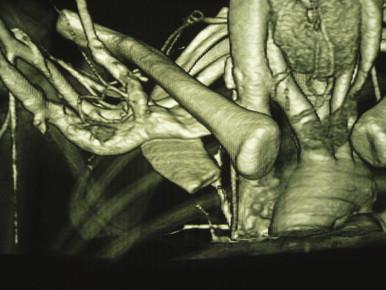 FIGURE 4, Computed tomography (CT) reconstruction of the costoclavicular junction, showing the subclavian vein being compressed by the (radiolucent) subclavius muscle.