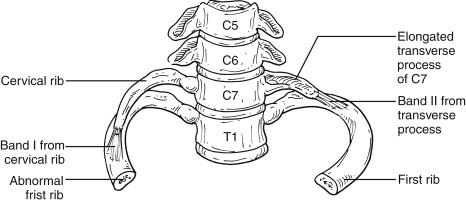 FIGURE 5, Elongated C7 transverse process with associated band (Roos 2) band on the patient’s left, and true cervical rib with articulation and associated band (Roos 1) on the patient’s right.