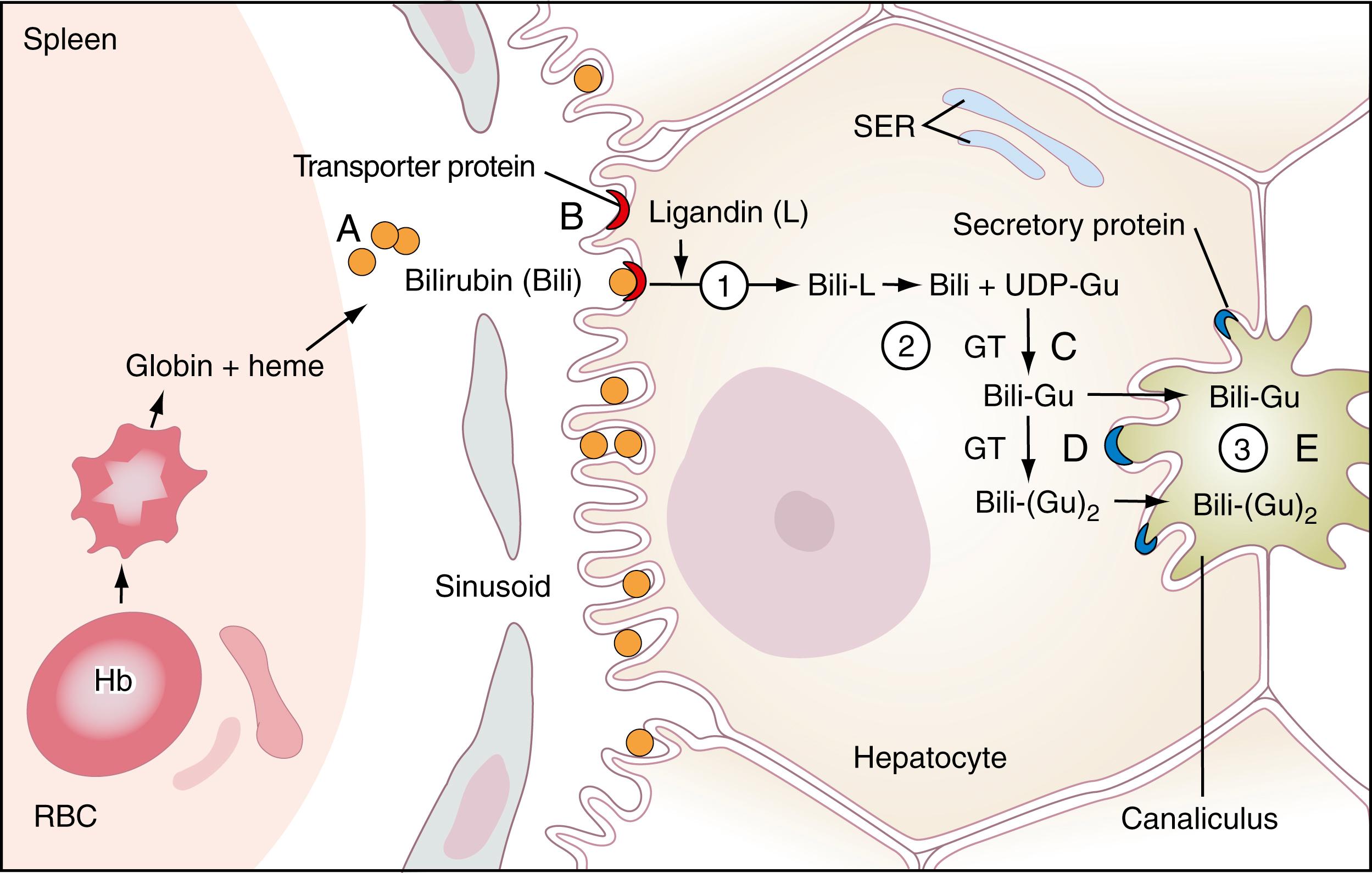 Figure 22.2, Schematic summary of the pathway of bilirubin (Bili, in brown circles) transport and metabolism. Bilirubin is produced from metabolism of heme, primarily in the spleen, and is transported to the liver bound to albumin. It enters the hepatocyte by binding to a transporter protein (red crescents) and crosses the cell membrane (circled 1) , thus entering the cell. It binds to Y and Z proteins (not shown) and then to ligandin for transport to the smooth endoplasmic reticulum (SER). In the SER, bilirubin is conjugated to glucuronic acid by UDP-glucuronyl transferase 1 (circled 2 and labeled GT) , producing monoglucuronides and diglucuronides of bilirubin: Bili-Gu and Bili-(Gu) 2 . Conjugated bilirubin is then secreted into the canaliculi (circled 3) by the adenosine triphosphate–binding cassette transporter protein MRP2/cMOAT/ABCC2 (shown as blue crescents) . In overproduction disease (A), such as hemolytic anemia, unconjugated bilirubin is produced at rates that exceed the ability of the liver to clear it, leading to a usually transient increase in unconjugated bilirubin in serum. In both Gilbert and Crigler-Najjar syndromes, mutations in the gene encoding UDP glucuronyl transferase (UDPGT1A1) , shown at C in the figure, result in buildup of unconjugated bilirubin in hepatocytes and ultimately in serum. In Gilbert syndrome, there may also be a defect in the bilirubin transporter protein, shown at B in the figure. Mutations in the MRP2/cMOAT/ABCC2 gene result in defective secretory proteins, causing buildup of conjugated bilirubin in hepatocytes and, ultimately, in serum, resulting in the Dubin-Johnson syndrome (D) , an autosomal-recessive disease. Conjugated hyperbilirubinemia is also found in Rotor syndrome, possibly virus induced. In adults, blockade of any of the major bile ducts, especially the common bile duct, by stones or space-occupying lesions such as tumors (E) , is the most common cause of conjugated hyperbilirubinemia. Hb, Hemoglobin; RBC, red blood cell.