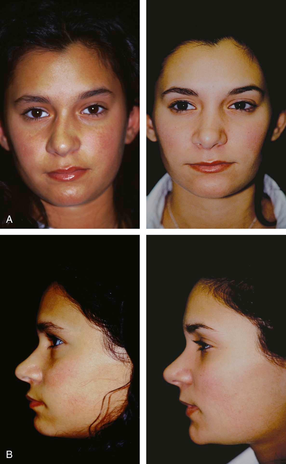 Figure 22-2, Patient with no history of antecedent nasal trauma. The patient developed progressive nasal deformity during adolescence. Examination demonstrated facial asymmetry with maxillary midline shifted to the right and nasal framework twisted and canted to the right, as well as a broad nasal tip. A shim spreader graft was created by drilling holes through a bone graft derived from the perpendicular plate of ethmoid. Medial and lateral osteotomies were performed to restore the nose to midline, and a dorsal onlay crushed cartilage graft was placed.