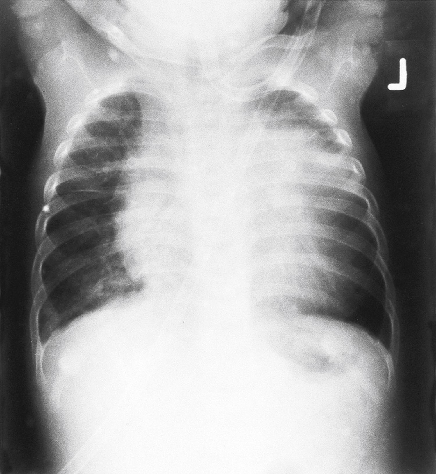 Fig. 3.3, Chest radiograph of a child with cor pulmonale secondary to obstructive sleep apnea.