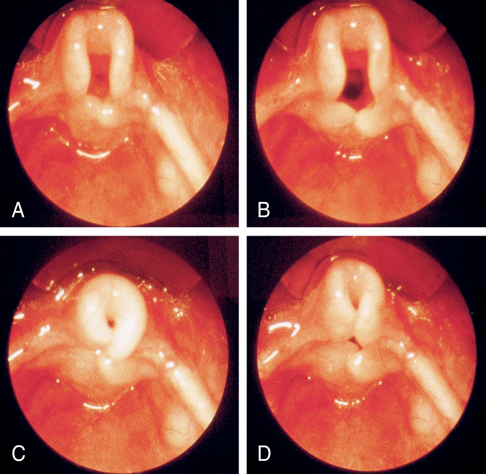 Fig. 27.2, Laryngomalacia. Progressive airway obstruction on inspiration. Note the omega-shaped epiglottis.