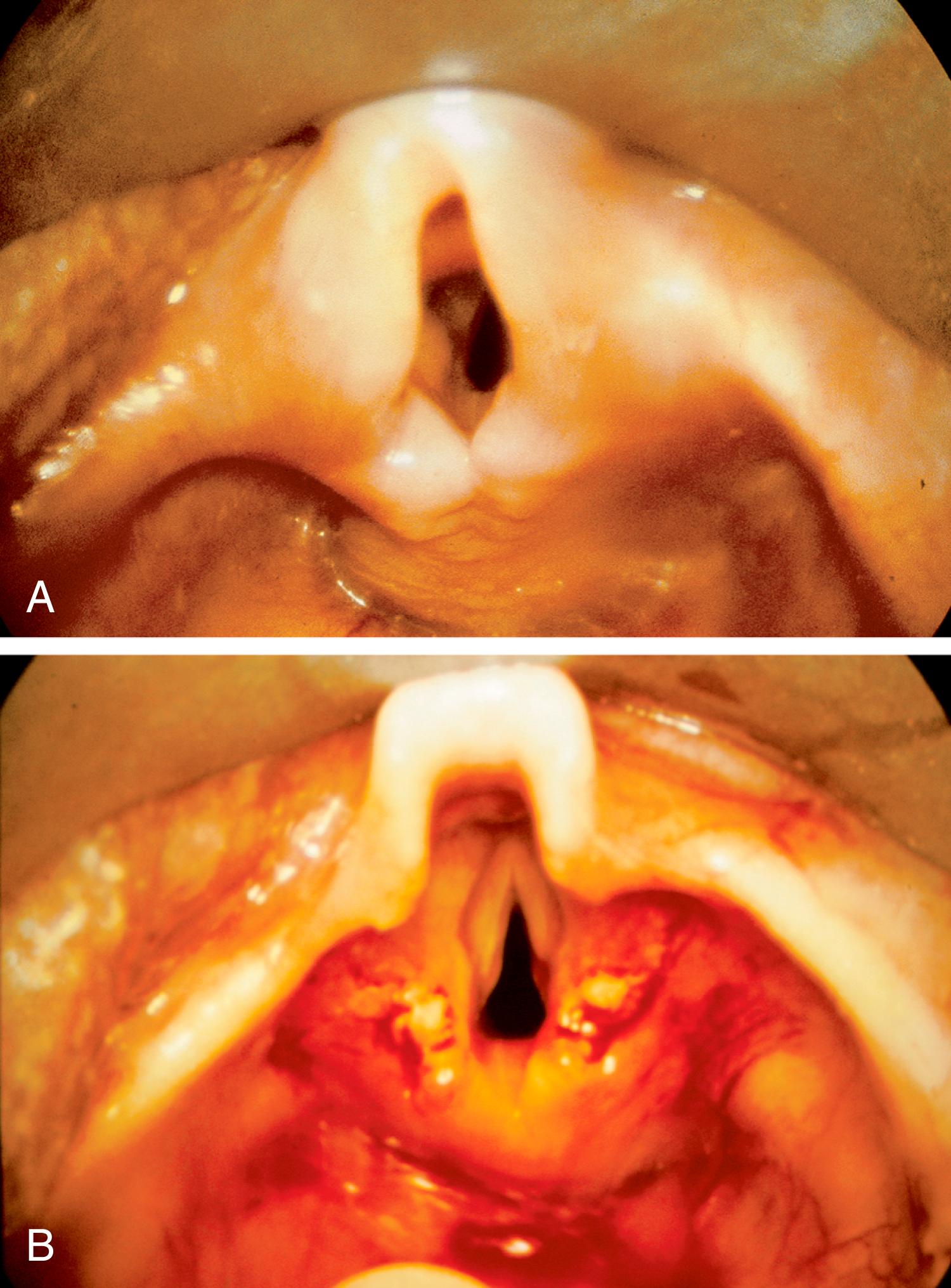 Fig. 27.3, Laryngomalacia. Infant larynx before (A) and after (B) supraglottoplasty.