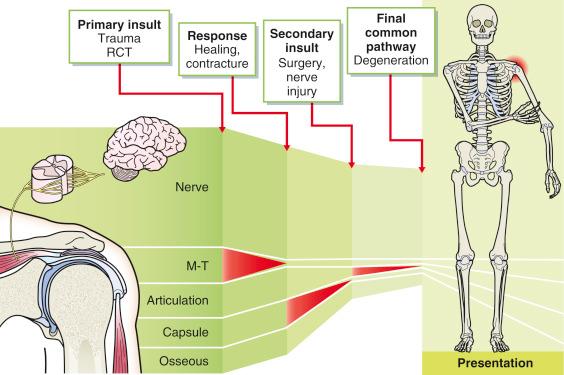 FIG.34.2, Pathoanatomy of the stiff shoulder. The initial insult was a fall, which produced a tear of the rotator cuff. The response is a failed attempt at healing and development of a capsular contracture with superior migration of the humeral head. The secondary insult is degeneration of the articular surface, which is the final common pathway. Note how anatomy, pathology, and time are linked. The presentation is due to three different pathologies of three anatomic structures at three different times. RCT, Rotator cuff tear; M-T, Musculotendon.