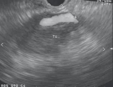 FIG 62.1, Endoscopic ultrasound images of a 2.9-cm hypoechoic, irregular pancreatic body mass encasing the splenic vessels. SA, Splenic artery; TU, tumor.