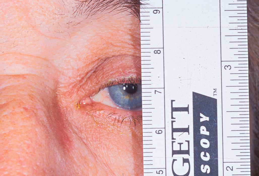 Figure 8.1, Measurement of the margin reflex distance (MRD) and the palpebral fissure. The MRD 1 is 1 mm. Often an estimate will suffice, 1 to 2 mm, in this case. The MRD 2 is 5 mm. The palpebral fissure is the sum of the MRD 1 and the MRD 2 .