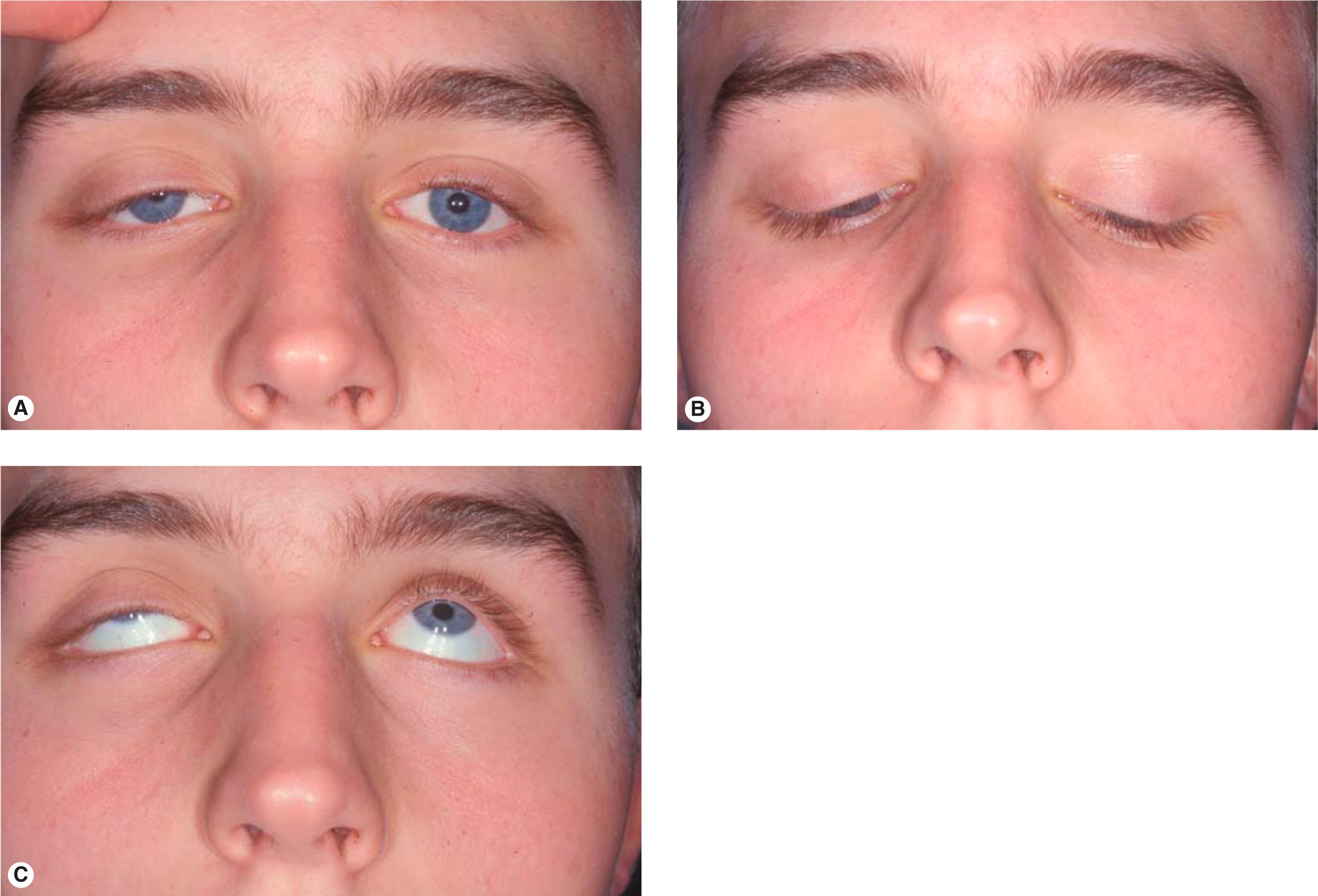 Figure 8.11, Characteristics of simple congenital ptosis, in this case bilateral and asymmetric. ( A ) Ptotic right upper eyelid with a weak skin crease. ( B ) The upper eyelid does not drop as far on the less ptotic side (lid lag on downgaze) because of the fibrosis in the weak levator muscle. ( C ) The upper eyelid does not elevate well (reduced levator function).