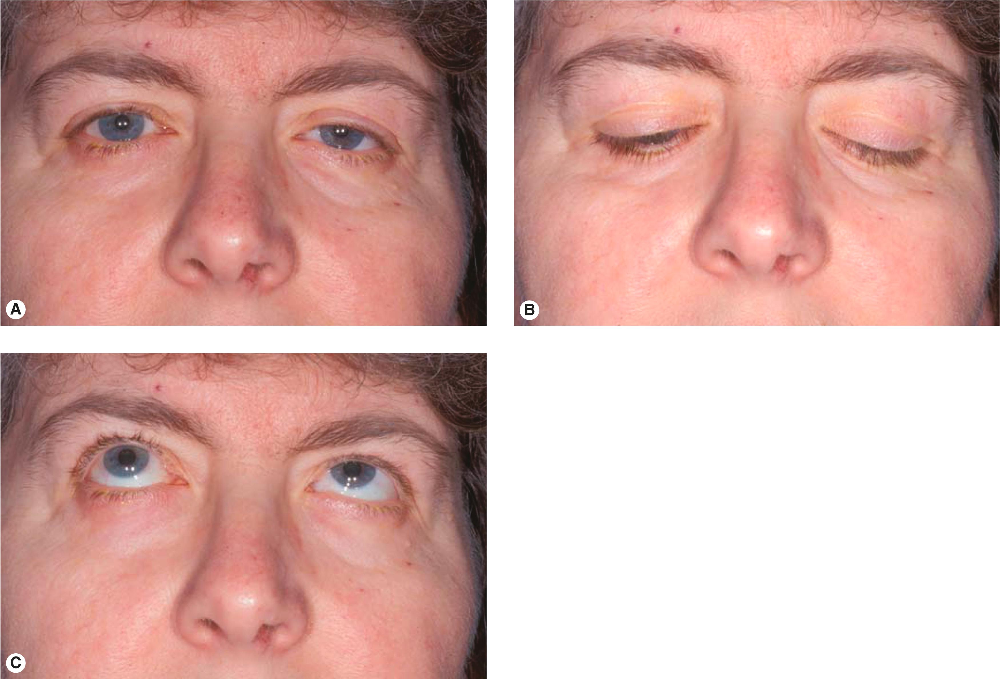 Figure 8.12, Characteristics of involutional ptosis. ( A ) Ptotic left upper eyelid with a high skin crease. ( B ) The upper eyelid shows lid drop on downgaze. ( C ) The levator function is normal.
