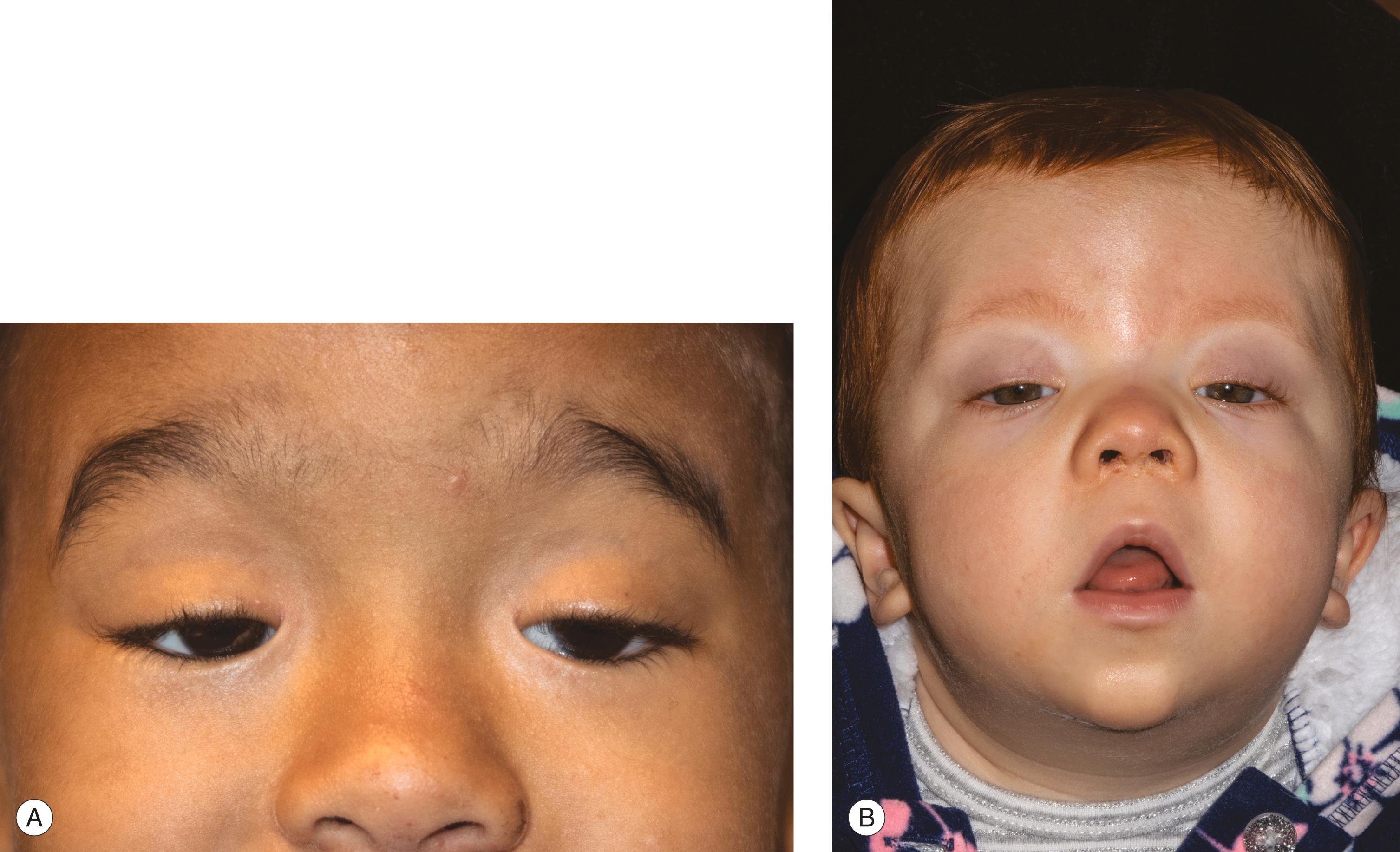 Figure 8.13, History suggesting an unusual form of ptosis. ( A ) Family history of congenital ptosis, or blepharophimosis syndrome (see Figure 8.35 ). ( B ) Ptosis associated with Noonan syndrome (rare).