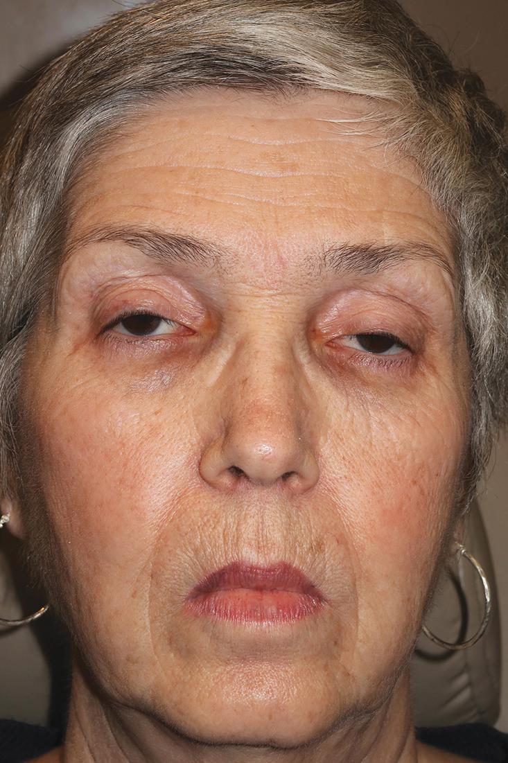Figure 8.16, Bilateral severe ptosis in a patient with progressive muscular dystrophy. Very little facial movement is present. Without any conscious thought you surmise that this patient has an unusual ptosis. Her ptosis repair probably needs to be conservative to avoid corneal exposure.