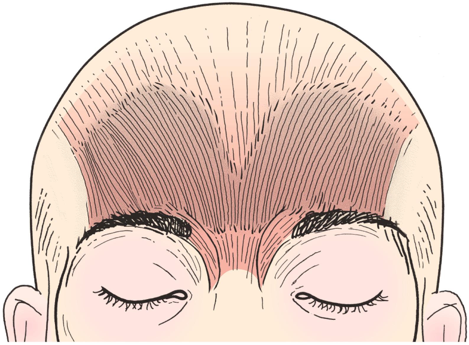 Figure 8.5, The frontalis muscle is a weak elevator of the eyelid.