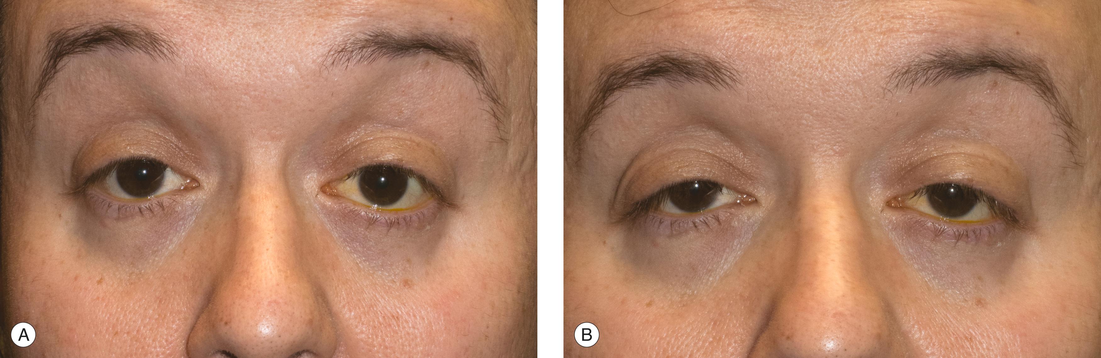 Figure 8.6, Frontalis muscle influence on MRD 1 measurement. When entering the examination room, I can see that the brows are very high. ( A ) The patient in normal gaze unconsciously lifting the eyebrows to clear the visual axis. ( B ) During a discussion the brows relax a bit and the ptosis becomes more noticeable. Note that the brows are still above normal position.