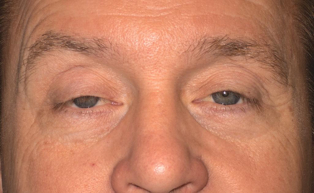 Figure 8.8, Adult with bilateral ptosis, associated with reduced levator function (5 mm in the right eye and 7 mm in the left eye). Upon questioning you learn that the ptosis has been present all his life. Your examination shows a simple congenital ptosis, presenting for treatment in an adult.