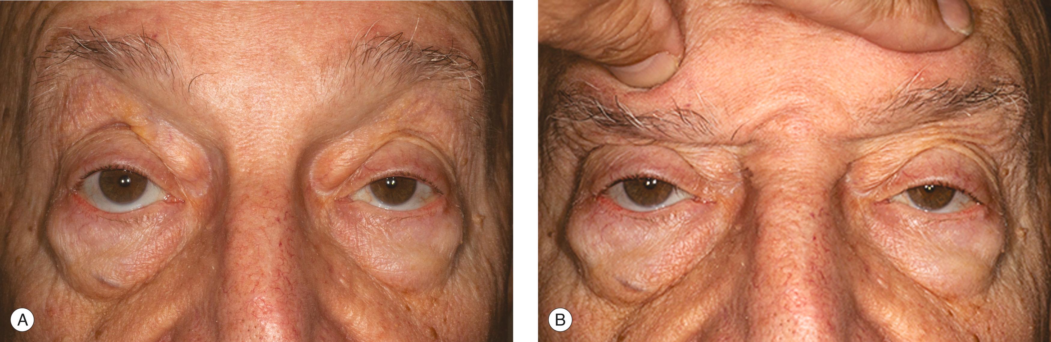 Figure 8.9, ( A ) Your patient’s level of alertness causes the eyelid height to vary considerably. This patient’s brows are always high to help eyelid elevation. ( B ) To accurately measure the MRD, push the eyebrows down into a relaxed position, so the frontalis muscle does not contribute to the eyelid elevation. Make sure the head is in a neutral position as you make the MRD measurements. With the eyebrows neutralized, the MRD 1 is significantly lower. The visual axis is barely cleared. This is the amount of ptosis that you aim to fix. You can see why patients have more visual complaints in the evening after holding the eyebrows up all day.