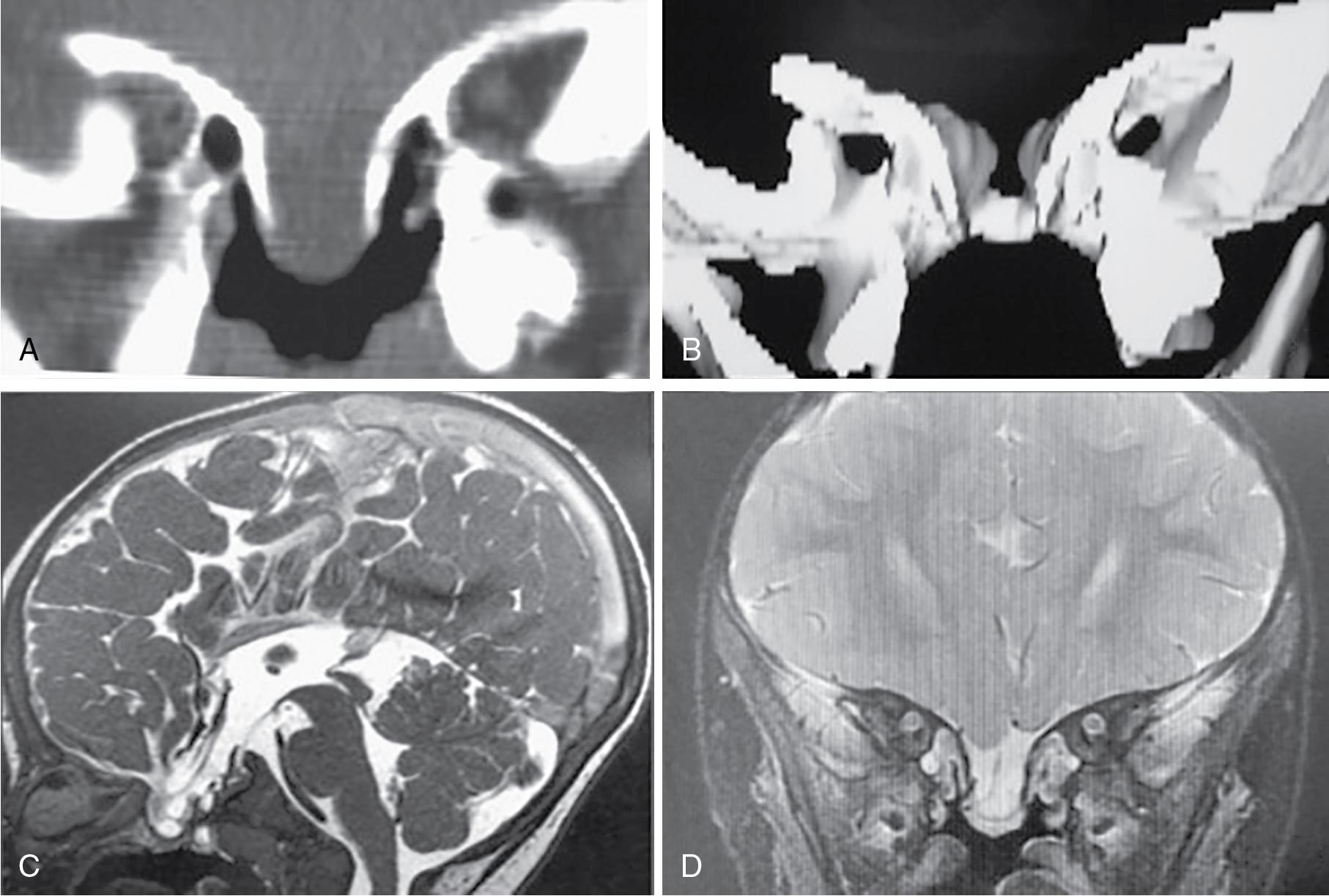 Fig. 20.1, A, Coronal computed tomography showing a skull base defect. B, Three-dimensional reconstruction of the same defect. Sagittal ( C ) and coronal ( D ) magnetic resonance images show a meningocystocele arising from the third ventricle.
