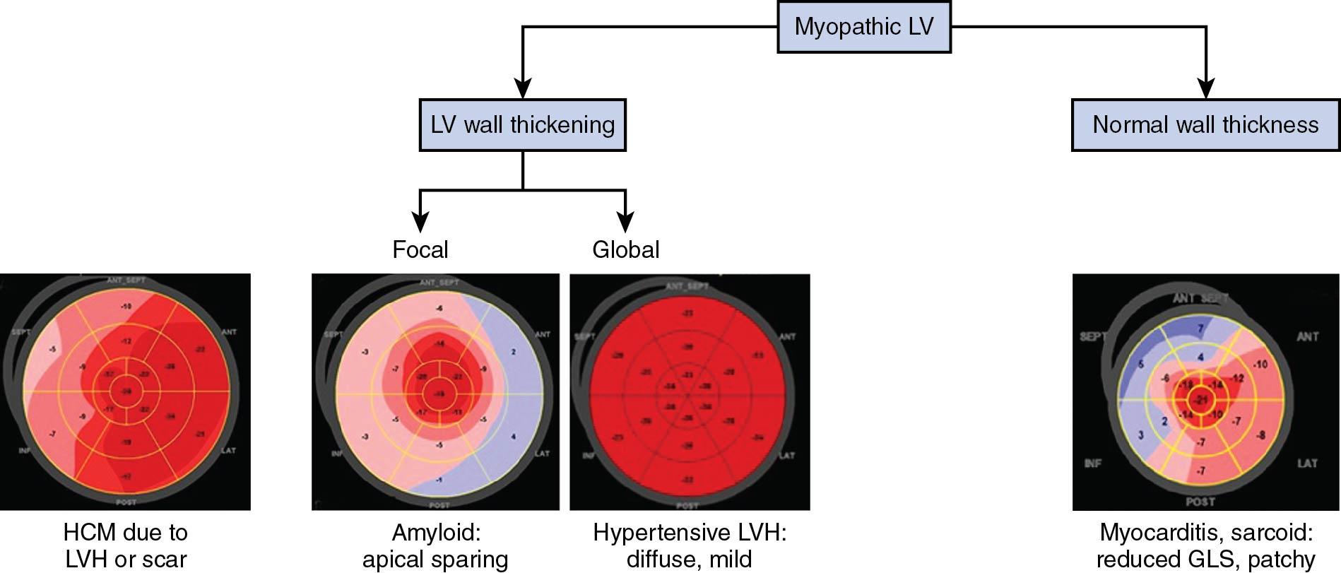 Central Illustration, Myopathic left ventricle (LV). GLS , Global longitudinal strain; HCM , hypertrophic cardiomopathy; LVH , left ventricular hyptertrophy.