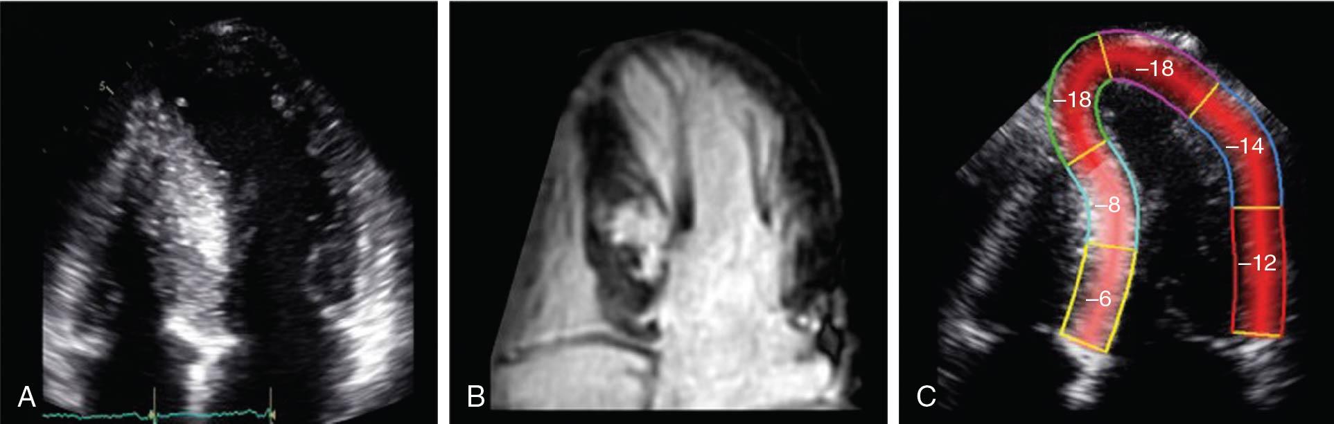 Fig. 4.4, Association of strain changes with wall thickening and fibrosis in hypertrophic cardiomyopathy (HCM). This patient, with typical HCM morphology of marked asymmetric septal hypertrophy ( A ), and delayed gadolinium enhancement consistent with transmural septal scar ( B ), shows reduced regional strain ( C ).