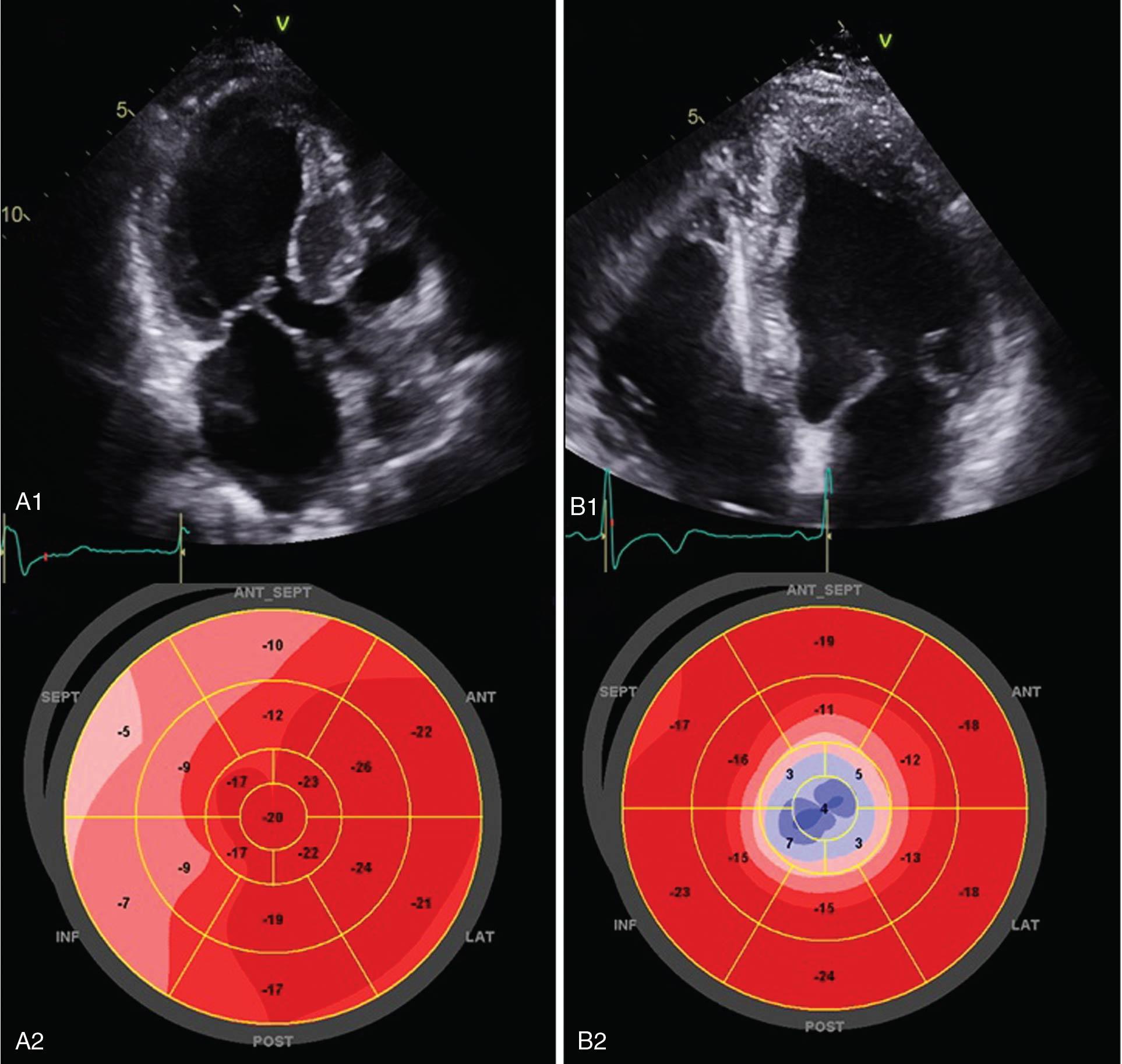 Fig. 4.5, Distribution of regional strain in hypertrophic cardiomyopathy (HCM). ( A1 ) Note a two-dimensional (2D) apical long axis image of a patient with septal hypertrophy with corresponding global longitudinal strain polar map ( A2 ) showing worse strain at the septum. ( B1 ) An apical four-chamber view of a patient with apical hypertrophic cardiomyopathy with corresponding strain map showing worse strain at the apex ( B2 ).