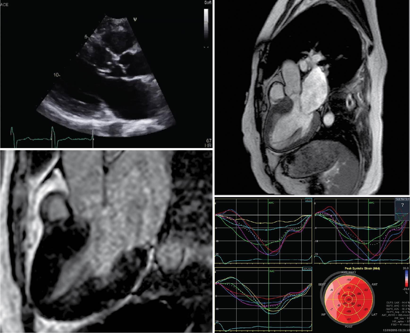 Video 4.1, Patient with severe septal hypertrophy with dynamic left ventricular outflow tract obstruction. Top panels show the long axis view on echocardiography and cine cardiac magnetic resonance imaging. Bottom left panel shows minimal delayed gadolinium enhancement. Strain analysis reveals reduction of strain at the site of greatest hypertrophy.